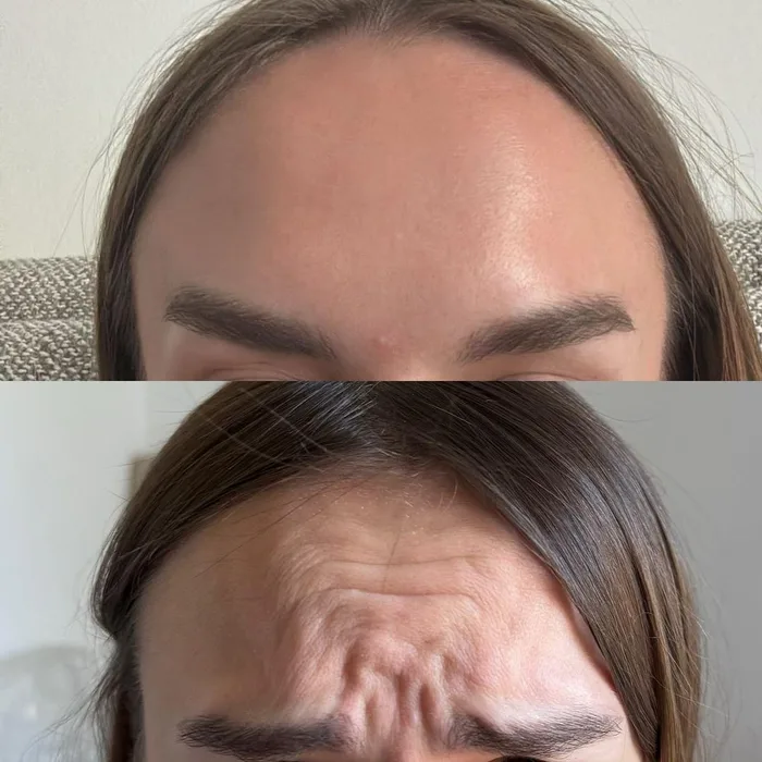 Botox Before and After - Forehead wrinkles