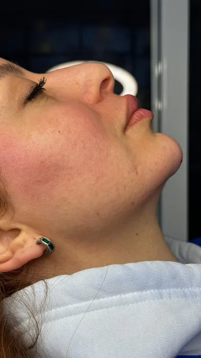 Jawline Filler - Profile sculpting