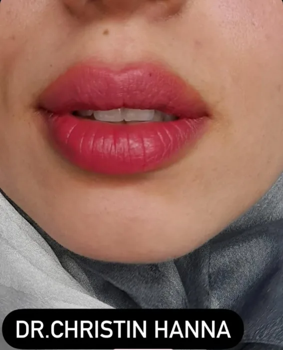 Lip Filler - Beautiful final result