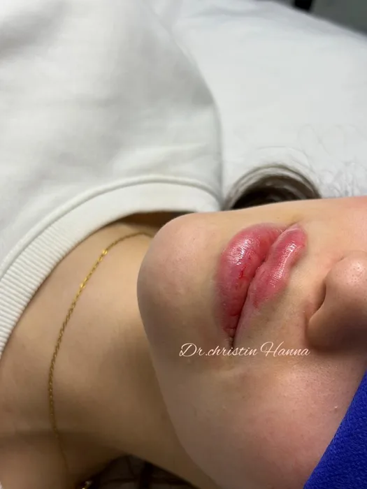 Lip Filler Result - Immediately after procedure