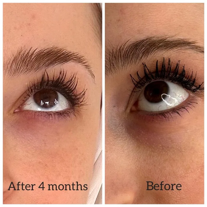 PDRN Salmon Therapy - Eye area before and after 4 months